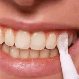 Teeth Whitening Gel