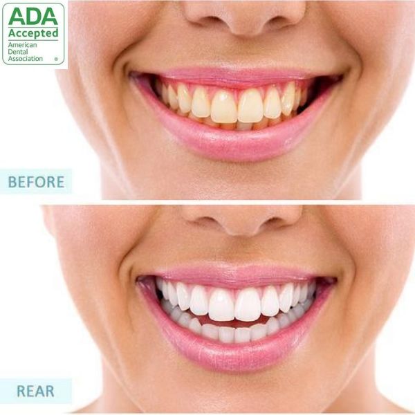 Tartar Removal (FDA APPROVED)