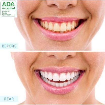 Tartar Removal (FDA APPROVED)